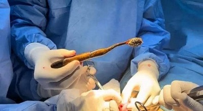 استخراج فرشاة أسنان من معدة مريضة في مستشفى ابن سينا بسرت