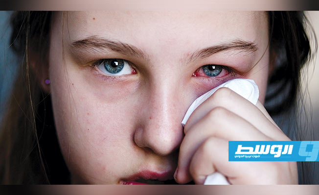 هل تصاب العيون بالإنفلونزا؟