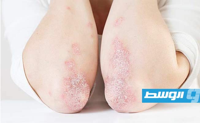 دراسة فرنسية: الأطعمة المُصنعة ترفع خطر الإصابة بـ«الصدفية»