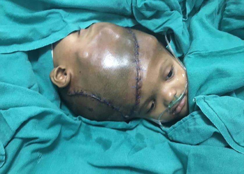 فصل توأمين سياميين متصلين بالرأس في الهند