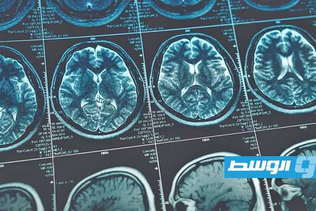 دراسة: تأثير خطير لدهون الجسم على تقليص حجم المخ