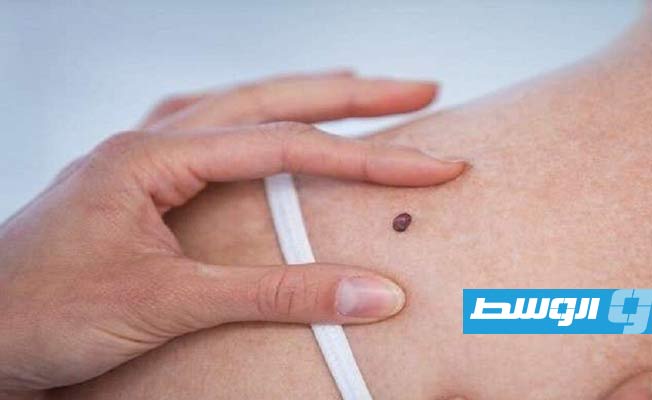 علامات تحول الشامة إلى سرطان الجلد