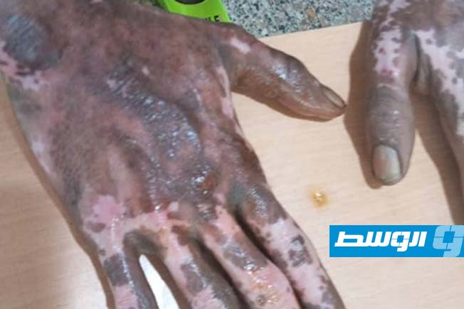 غلق مطعم في أجدابيا يديره وافد مصاب بمرض جلدي