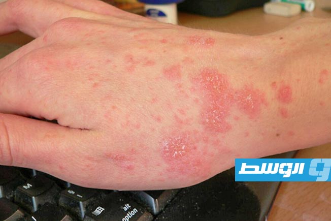 بريطانيا تسجل ارتفاعا في معدلات الإصابة بالجرب