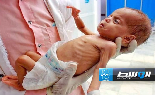 «يونيسف»: 50 ألف طفل بغزة يعانون سوء التغذية الحاد