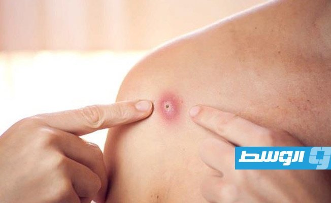 باكستان تسجّل أول حالة إصابة بفيروس جدري القرود