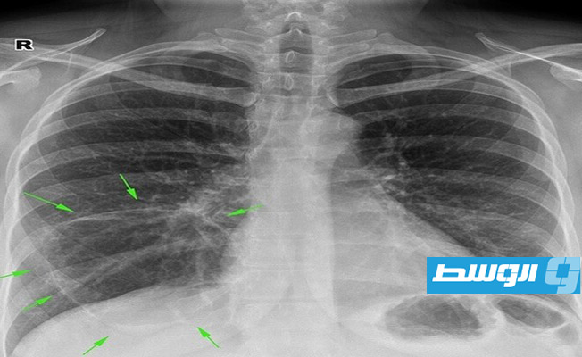 تحديد فيروس «كورونا» من خلال صور الأشعة السينية