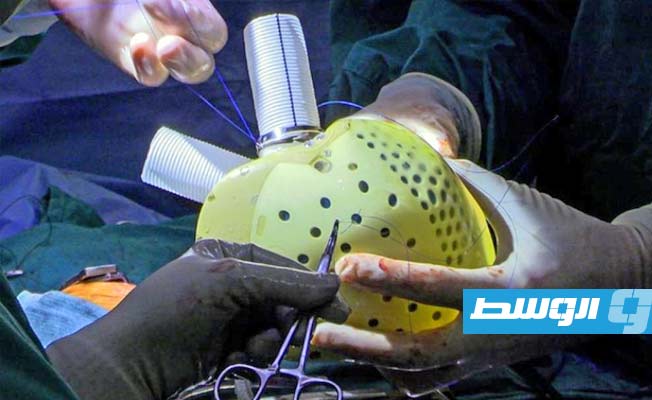 للمرة الأولى.. نجاح عملية زرع أعصاب بذراع مشلولة في إيطاليا
