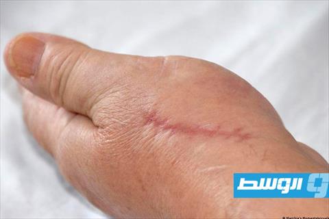 خلطة طبيعية منزلية للتخفيف من آثار الجروح