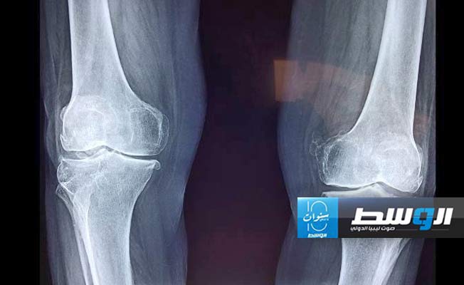 «القاتل الصامت».. كيفية الوقاية من مرض هشاشة العظام
