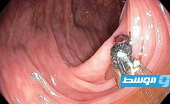 ذبابة سليمة داخل أمعاء رجل تحير الأطباء!