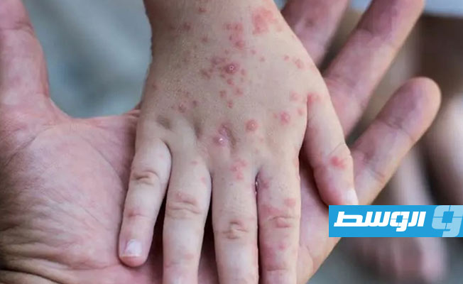 أميركا تعلن جدري القردة حالة طوارئ صحية عامة