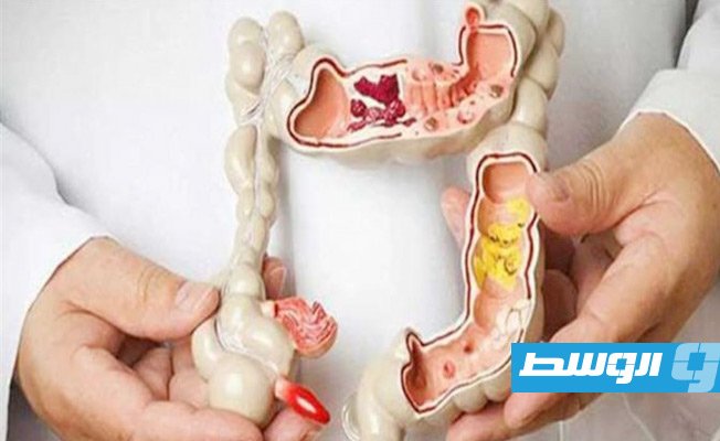 اكتشاف هرمون قد يكون وراء الإصابة بمتلازمة القولون العصبي المصحوبة بالإسهال