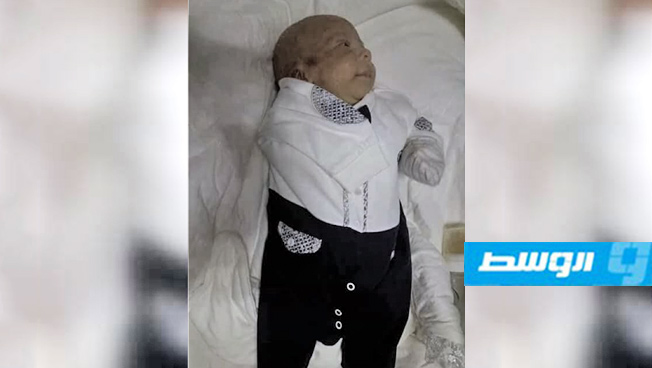 مسؤول بـ«صحة المؤقتة» يكشف عن احتمالين وراء بتر يد طفل المرج‎