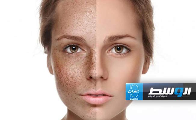 تخلصي من الكلف في أسبوع
