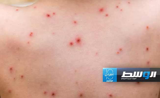 «الصحة العالمية» تحذّر من حالات جديدة من «جدري القرود» في أوروبا