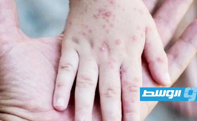 أميركا ترصد أول إصابتين بجدري القرود بين الأطفال
