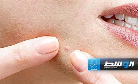 القرفة وزيت النعناع للتخلص من البثور