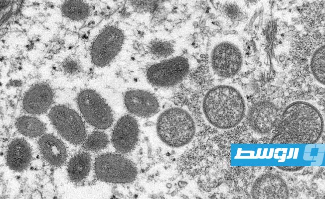 أكثر من 700 إصابة بجدري القرود عالميا و21 في الولايات المتحدة