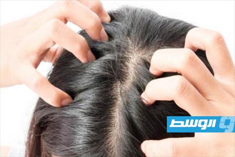 طرق طبيعية للتخلص من جفاف فروة الرأس