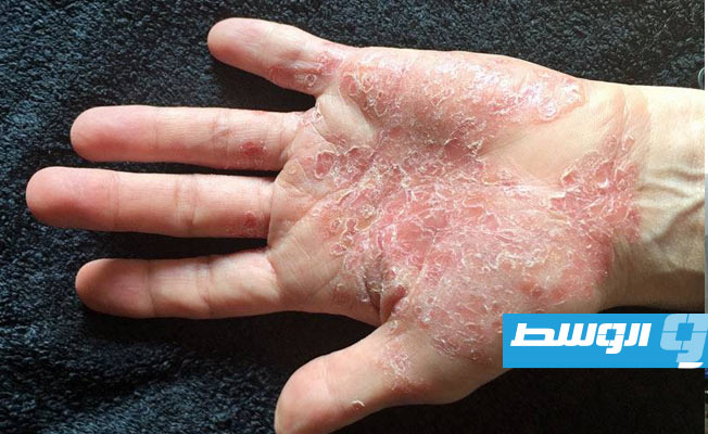 التجارب تثبت فاعلية هذا العقار في تخفيف أعراض مرض جلدي مؤلم