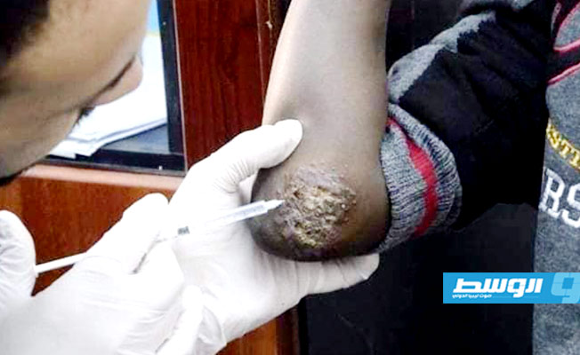 رصد 48 حالة مصابة بالليشمانيا خلال اليومين الماضيين في بني وليد