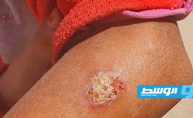 تسجيل حالة إصابة بمرض «اللشمانيا» في بني وليد