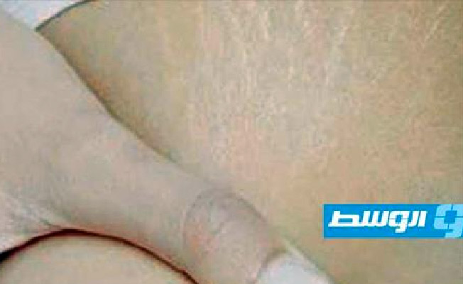 الردة والزنجبيل للتخلص من علامات التمدد