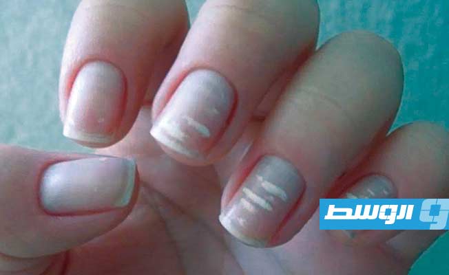 ذهبت إلى مركز تجميل للاعتناء بأظافرها فعادت بسرطان قاتل