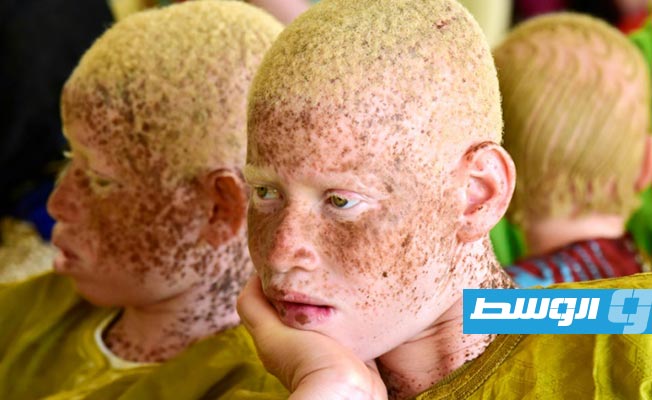 مرضى المهق عرضة للإصابة بسرطان الجلد