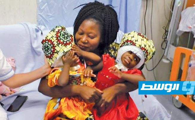 نجاح فصل توأمين سياميتين موصولتين عند مستوى الجمجمة
