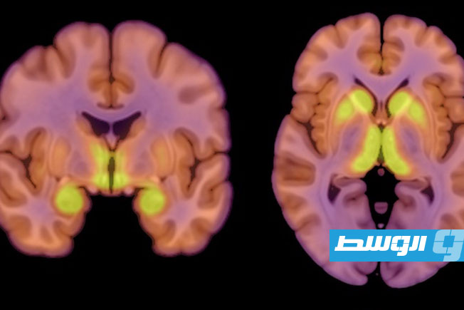 دراسة جديدة تكشف عن نمط مميز في نشاط الدماغ لدى مرضى فقدان الشهية العصبي
