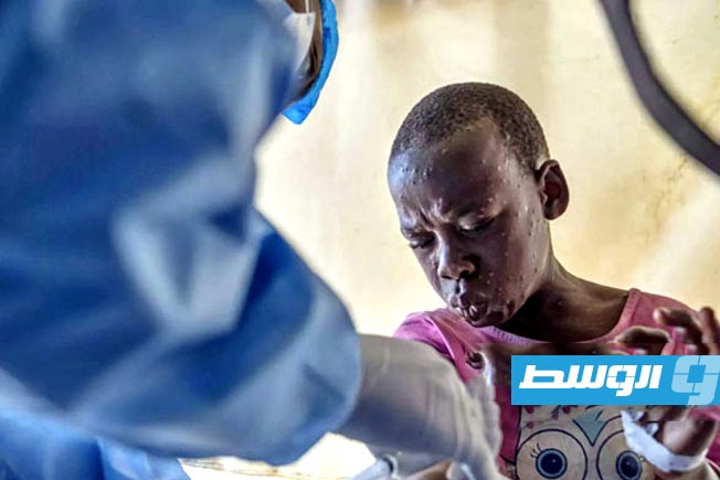 «الصحة العالمية» تبقي التحذير من جدري القرود «إمبوكس» عند أعلى مستوى