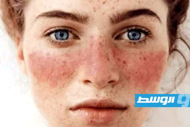 أعراض الذئبة الحمراء تنحسر مع تقدم العمر