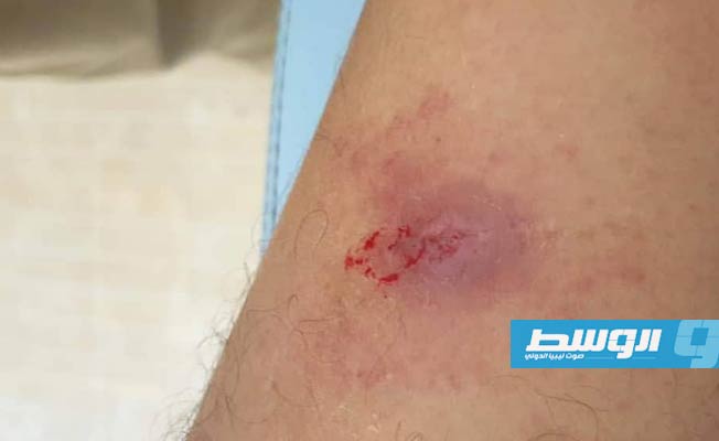 ارتفاع عدد الإصابات بـ«اللشمانيا» في بني وليد إلى 47 حالة