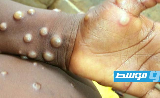 «الصحة العالمية» تلغى أعلى درجات التحذير من جدري «إم بوكس»