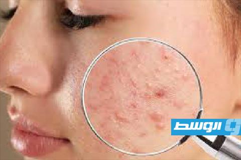 تخلّصي من آثار البثور بمكونين فقط في مطبخك