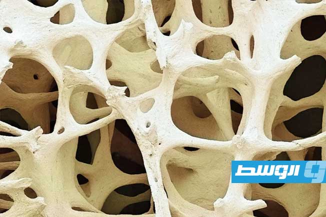 نقص الكثافة العظمية «مرض صامت» يهدد 40% من البالغين حول العالم