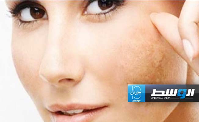وصفات طبيعية للتخلص من البقع الداكنة